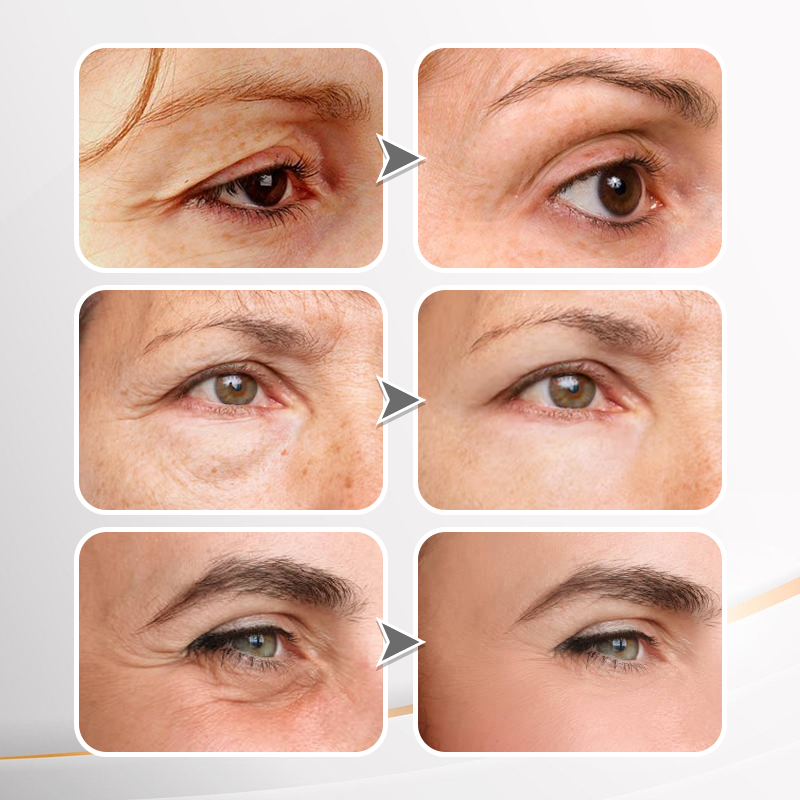 🎉Last Day Discount: 87% OFF💐Instant Wrinkle Eye Tightener cream-Best Selling🎉