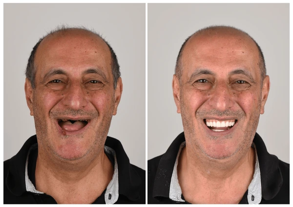 🦷 NESLEMY™ Custom-Fit Functional Dentures 😁 Smile with Confidence