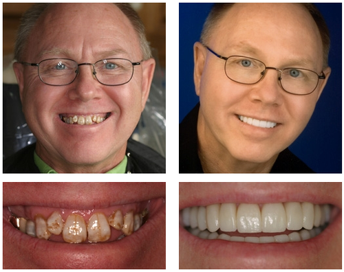 🦷 NESLEMY™ Custom-Fit Functional Dentures 😁 Smile with Confidence