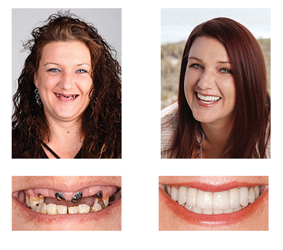 🦷 NESLEMY™ Custom-Fit Functional Dentures 😁 Smile with Confidence