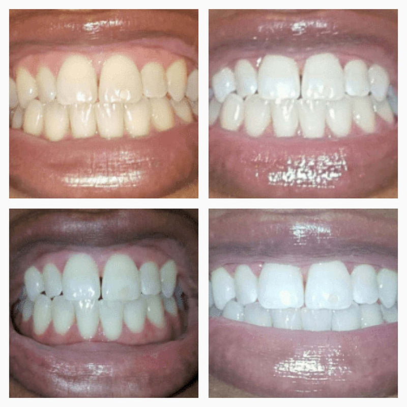 💖Extra-Strength Teeth Whitening Serum Pen + Dual-Peroxide Formula & Xylitol