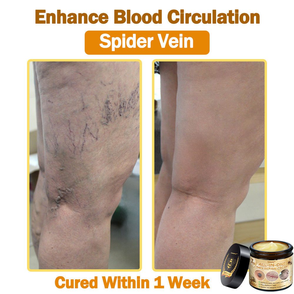 [𝐎𝐟𝐟𝐢𝐜𝐢𝐚𝐥 𝐁𝐫𝐚𝐧𝐝 𝐒𝐭𝐨𝐫𝐞] 🐝 𝐋𝐞𝐧𝐚𝐫𝐨™ 𝐁𝐞𝐞 𝐕𝐞𝐧𝐨𝐦 𝐀𝐥𝐥-𝐢𝐧-𝐎𝐧𝐞 𝐂𝐫𝐞𝐚𝐦 𝐔𝐒 𝐃𝐞𝐫𝐦𝐚𝐭𝐨𝐥𝐨𝐠𝐢𝐬𝐭 𝐀𝐩𝐩𝐫𝐨𝐯𝐞𝐝 (👩‍⚕️ 𝐀𝐦𝐞𝐫𝐢𝐜𝐚𝐧 𝐀𝐜𝐚𝐝𝐞𝐦𝐲 𝐨𝐟 𝐃𝐞𝐫𝐦𝐚𝐭𝐨𝐥𝐨𝐠𝐲 𝟐𝟎𝟐𝟓 𝐒𝐩𝐞𝐜𝐢𝐚𝐥𝐥𝐲 𝐑𝐞𝐜𝐨𝐦𝐦𝐞𝐧𝐝𝐞𝐝 𝐏𝐫𝐨𝐝𝐮𝐜𝐭)