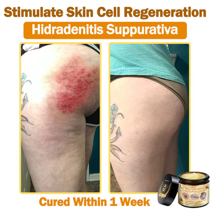 [𝐎𝐟𝐟𝐢𝐜𝐢𝐚𝐥 𝐁𝐫𝐚𝐧𝐝 𝐒𝐭𝐨𝐫𝐞] 🐝 𝐋𝐞𝐧𝐚𝐫𝐨™ 𝐁𝐞𝐞 𝐕𝐞𝐧𝐨𝐦 𝐀𝐥𝐥-𝐢𝐧-𝐎𝐧𝐞 𝐂𝐫𝐞𝐚𝐦 𝐔𝐒 𝐃𝐞𝐫𝐦𝐚𝐭𝐨𝐥𝐨𝐠𝐢𝐬𝐭 𝐀𝐩𝐩𝐫𝐨𝐯𝐞𝐝 (👩‍⚕️ 𝐀𝐦𝐞𝐫𝐢𝐜𝐚𝐧 𝐀𝐜𝐚𝐝𝐞𝐦𝐲 𝐨𝐟 𝐃𝐞𝐫𝐦𝐚𝐭𝐨𝐥𝐨𝐠𝐲 𝟐𝟎𝟐𝟓 𝐒𝐩𝐞𝐜𝐢𝐚𝐥𝐥𝐲 𝐑𝐞𝐜𝐨𝐦𝐦𝐞𝐧𝐝𝐞𝐝 𝐏𝐫𝐨𝐝𝐮𝐜𝐭)