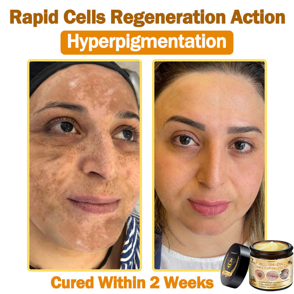 [𝐎𝐟𝐟𝐢𝐜𝐢𝐚𝐥 𝐁𝐫𝐚𝐧𝐝 𝐒𝐭𝐨𝐫𝐞] 🐝 𝐋𝐞𝐧𝐚𝐫𝐨™ 𝐁𝐞𝐞 𝐕𝐞𝐧𝐨𝐦 𝐀𝐥𝐥-𝐢𝐧-𝐎𝐧𝐞 𝐂𝐫𝐞𝐚𝐦 𝐔𝐒 𝐃𝐞𝐫𝐦𝐚𝐭𝐨𝐥𝐨𝐠𝐢𝐬𝐭 𝐀𝐩𝐩𝐫𝐨𝐯𝐞𝐝 (👩‍⚕️ 𝐀𝐦𝐞𝐫𝐢𝐜𝐚𝐧 𝐀𝐜𝐚𝐝𝐞𝐦𝐲 𝐨𝐟 𝐃𝐞𝐫𝐦𝐚𝐭𝐨𝐥𝐨𝐠𝐲 𝟐𝟎𝟐𝟓 𝐒𝐩𝐞𝐜𝐢𝐚𝐥𝐥𝐲 𝐑𝐞𝐜𝐨𝐦𝐦𝐞𝐧𝐝𝐞𝐝 𝐏𝐫𝐨𝐝𝐮𝐜𝐭)