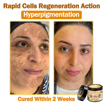 [𝐎𝐟𝐟𝐢𝐜𝐢𝐚𝐥 𝐁𝐫𝐚𝐧𝐝 𝐒𝐭𝐨𝐫𝐞] 🐝 𝐋𝐞𝐧𝐚𝐫𝐨™ 𝐁𝐞𝐞 𝐕𝐞𝐧𝐨𝐦 𝐀𝐥𝐥-𝐢𝐧-𝐎𝐧𝐞 𝐂𝐫𝐞𝐚𝐦 𝐔𝐒 𝐃𝐞𝐫𝐦𝐚𝐭𝐨𝐥𝐨𝐠𝐢𝐬𝐭 𝐀𝐩𝐩𝐫𝐨𝐯𝐞𝐝 (👩‍⚕️ 𝐀𝐦𝐞𝐫𝐢𝐜𝐚𝐧 𝐀𝐜𝐚𝐝𝐞𝐦𝐲 𝐨𝐟 𝐃𝐞𝐫𝐦𝐚𝐭𝐨𝐥𝐨𝐠𝐲 𝟐𝟎𝟐𝟓 𝐒𝐩𝐞𝐜𝐢𝐚𝐥𝐥𝐲 𝐑𝐞𝐜𝐨𝐦𝐦𝐞𝐧𝐝𝐞𝐝 𝐏𝐫𝐨𝐝𝐮𝐜𝐭)