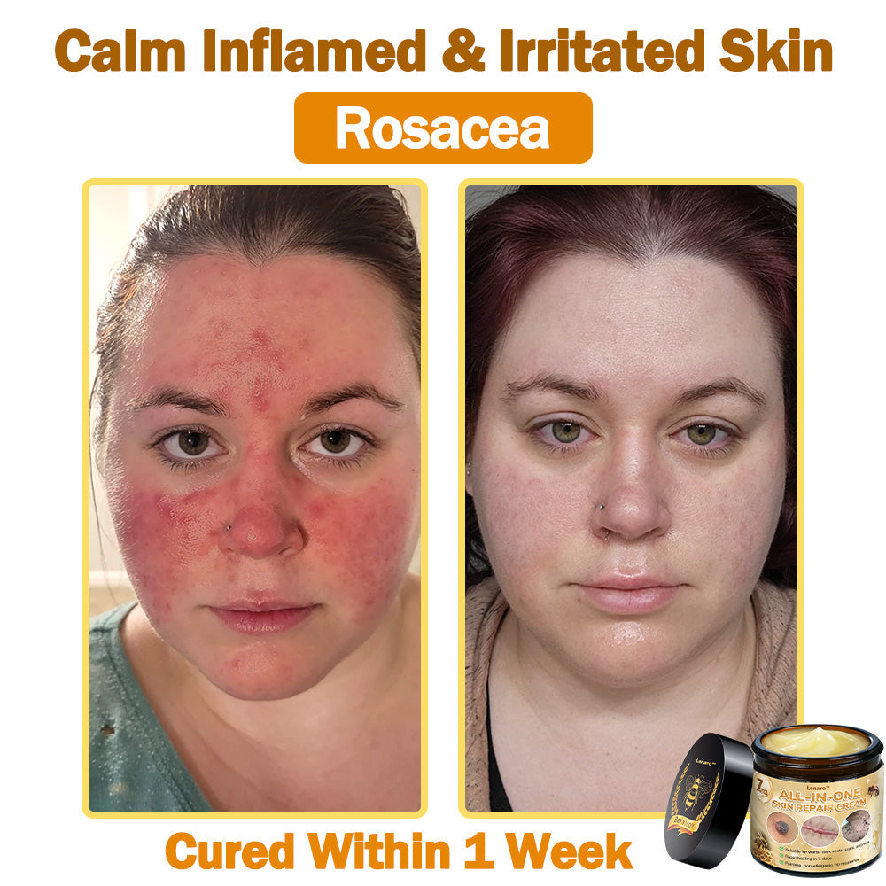 [𝐎𝐟𝐟𝐢𝐜𝐢𝐚𝐥 𝐁𝐫𝐚𝐧𝐝 𝐒𝐭𝐨𝐫𝐞] 🐝 𝐋𝐞𝐧𝐚𝐫𝐨™ 𝐁𝐞𝐞 𝐕𝐞𝐧𝐨𝐦 𝐀𝐥𝐥-𝐢𝐧-𝐎𝐧𝐞 𝐂𝐫𝐞𝐚𝐦 𝐔𝐒 𝐃𝐞𝐫𝐦𝐚𝐭𝐨𝐥𝐨𝐠𝐢𝐬𝐭 𝐀𝐩𝐩𝐫𝐨𝐯𝐞𝐝 (👩‍⚕️ 𝐀𝐦𝐞𝐫𝐢𝐜𝐚𝐧 𝐀𝐜𝐚𝐝𝐞𝐦𝐲 𝐨𝐟 𝐃𝐞𝐫𝐦𝐚𝐭𝐨𝐥𝐨𝐠𝐲 𝟐𝟎𝟐𝟓 𝐒𝐩𝐞𝐜𝐢𝐚𝐥𝐥𝐲 𝐑𝐞𝐜𝐨𝐦𝐦𝐞𝐧𝐝𝐞𝐝 𝐏𝐫𝐨𝐝𝐮𝐜𝐭)